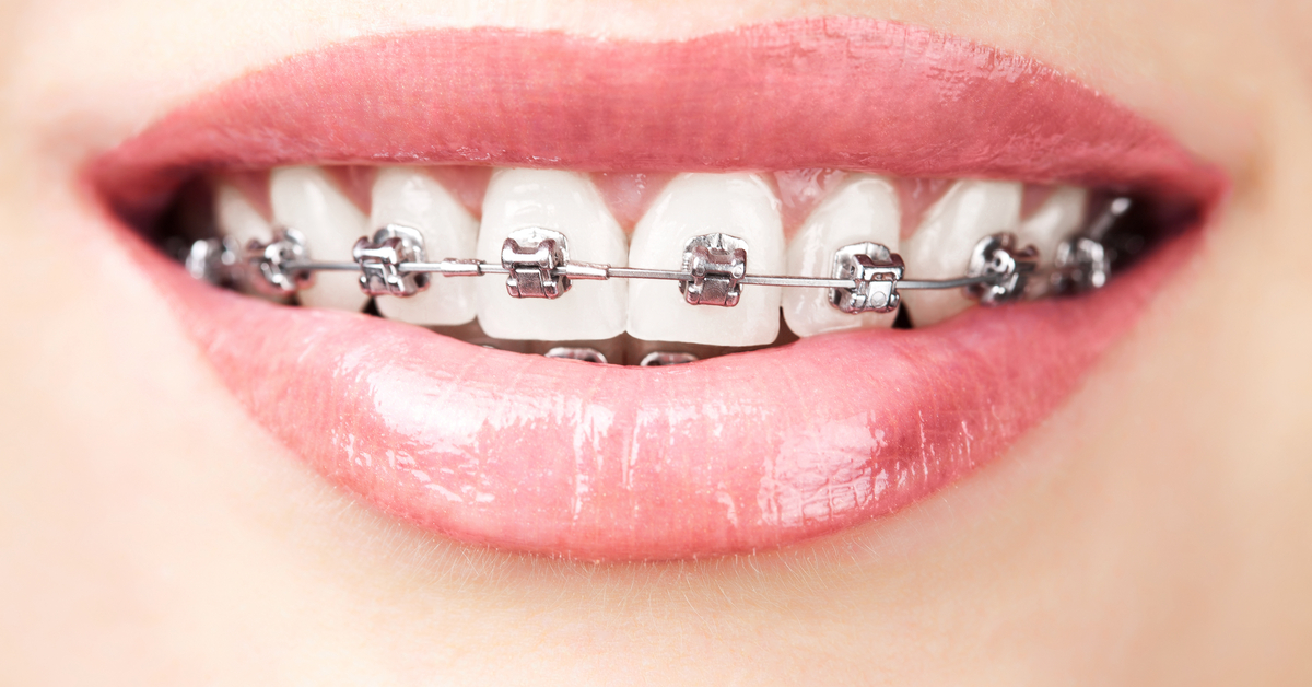 10 Things That Only Someone Who Has Worn Braces Before Would Understand