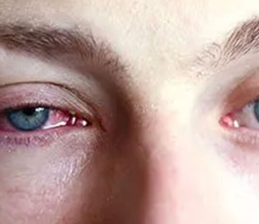 6 Scary Consequences of Wearing Contact Lens to Sleep That You Probably Didn’t Know About
