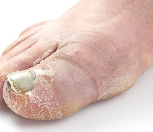 Everything You Need To Know About ‘Foot Rot’—Every NSF’s Worst Enemy