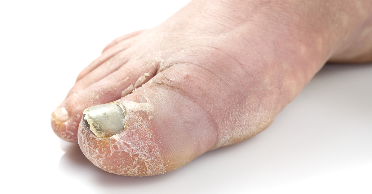 Everything You Need To Know About Foot Rot Every NSF s Worst Enemy 