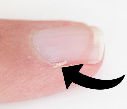 8 Facts About Hangnails, The Annoying Thing That Comes Whenever It Feels Like Doing So