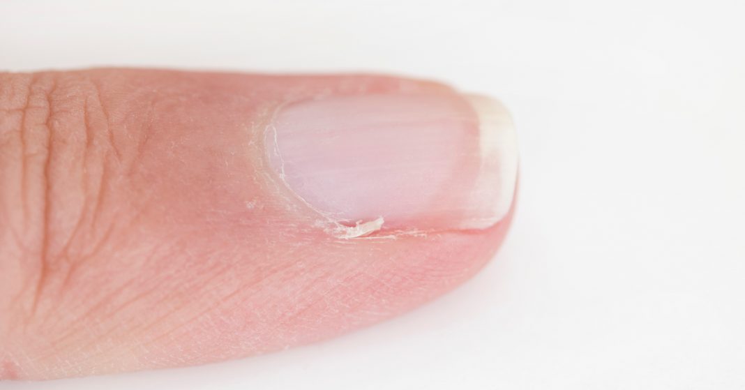 8 Facts About Hangnails, The Annoying Thing That Comes Whenever It ...