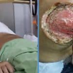 Malaysian Who Drank at Least 2 Soft Drinks Every Day Almost Loses Arm