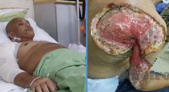 Malaysian Who Drank at Least 2 Soft Drinks Every Day Almost Loses Arm