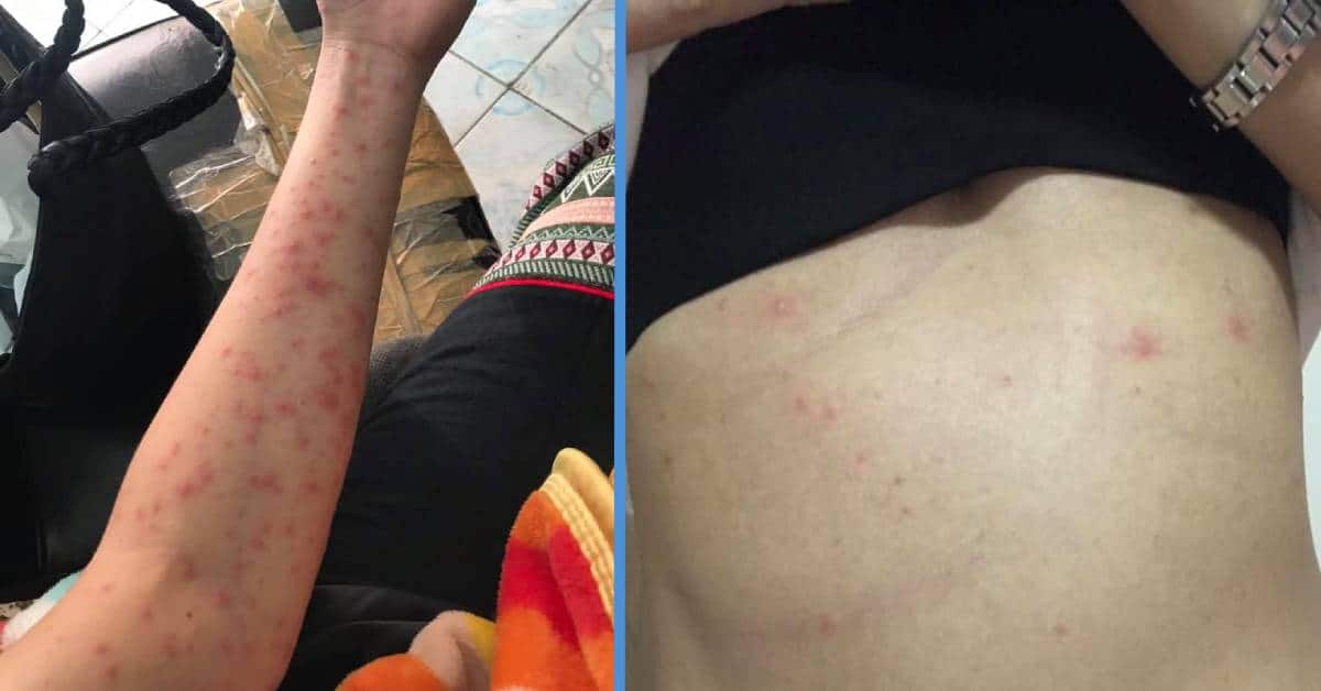 Woman Suffered Terrible Rash On Body After Three Months of Working Late