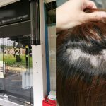Woman Got Large Bald Spot While Straightening & Dyeing Hair; Salon Denies Wrongdoing After Customer Demands $10k Compensation