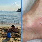 Man Stung by Stingray at Sentosa Spends 4 Days in SGH; Wasn’t The Only One Stung