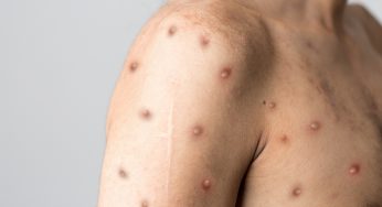 Monkeypox Will Now be Renamed to Mpox
