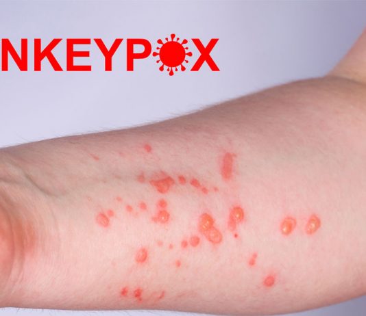 Health Minister Explains Why We Might Find Mpox Cases in Singapore