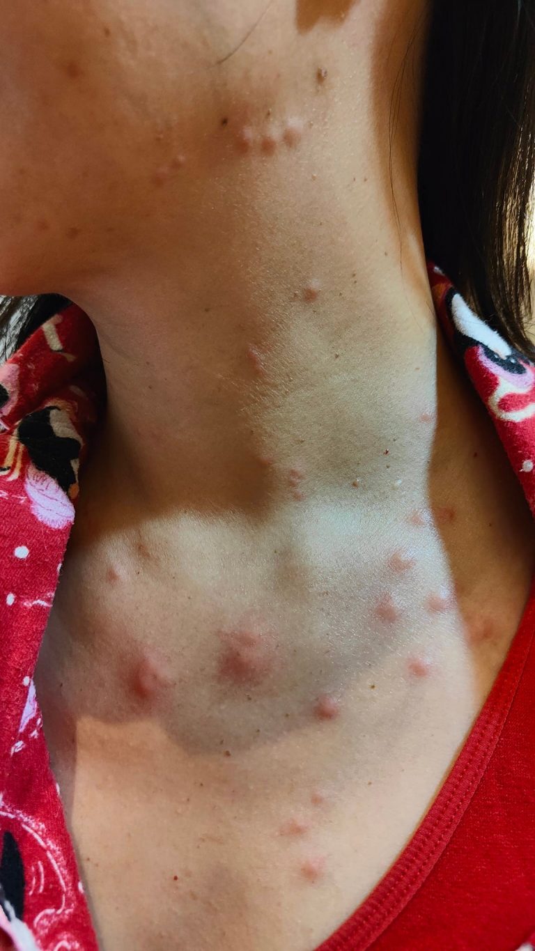 Guests Bitten by Bed Bugs in Jalan Basar Hotel Dismiss Claims That They