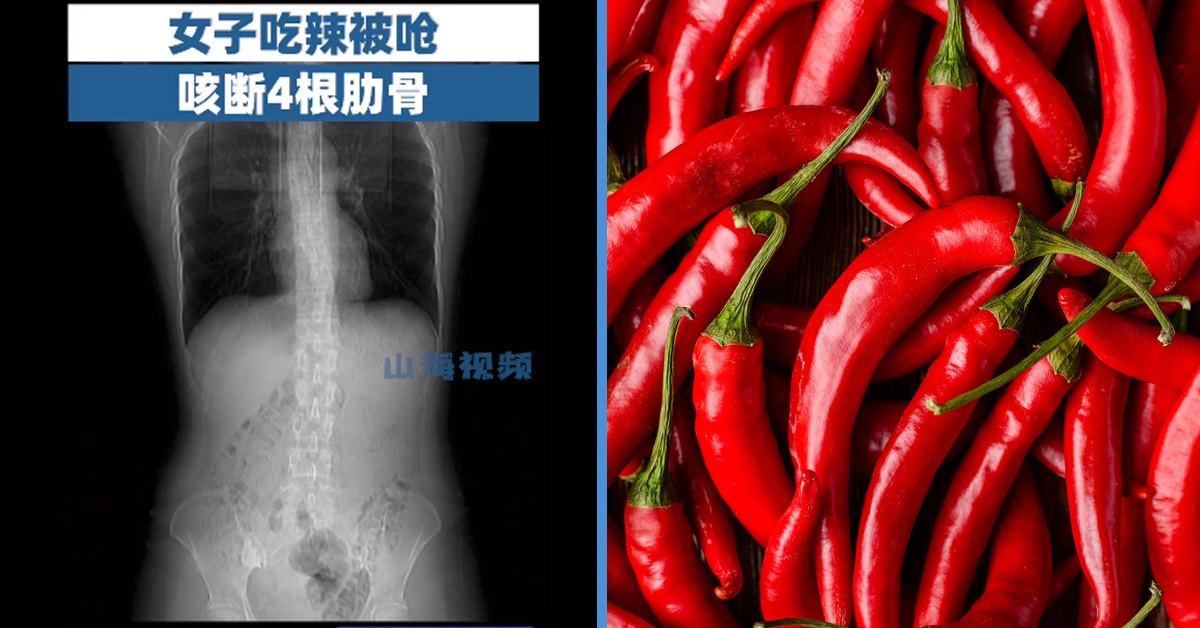 Woman Broke Her Ribs from Coughing After Eating an Extra Spicy Meal