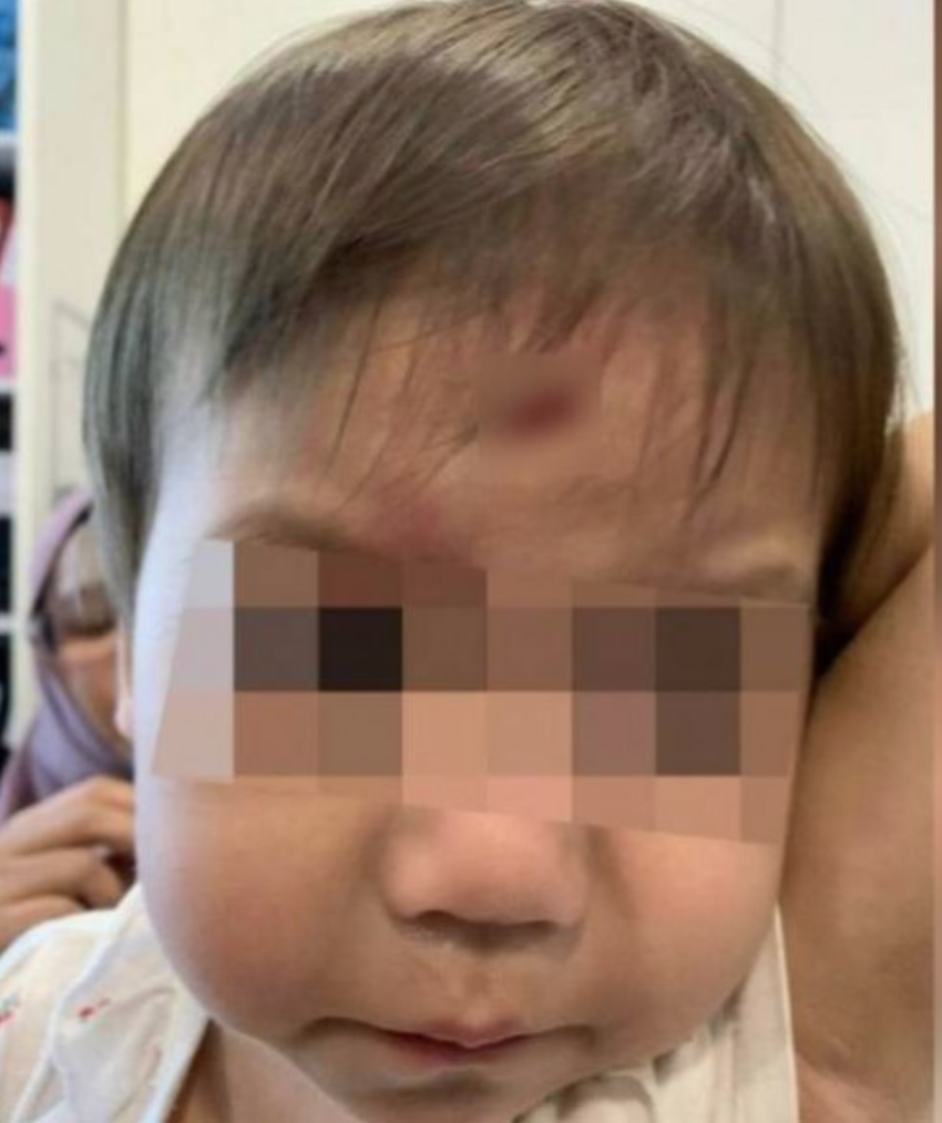 18 Month old Toddler Trips Over Preschool Teacher s Foot Suffers 