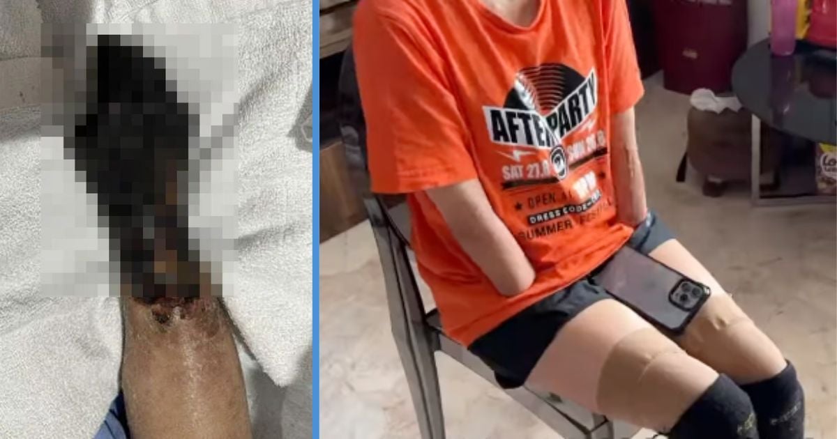 37Y0 M'sian Working in S'pore Had to Amputate 4 Limbs Due to Bacterial Infection