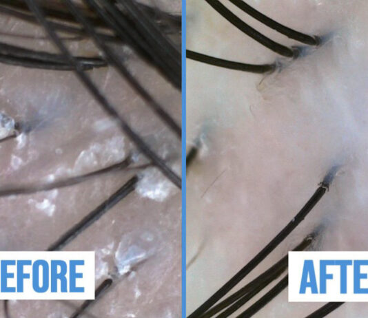 I Blamed Stress, Hormones, and Even My Pillowcase for my Hair Loss, But the Problem Was My Scalp