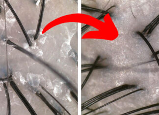 I Always Thought Hair Loss Only Comes With Old Age, Little Did I Know That I Was So Wrong…