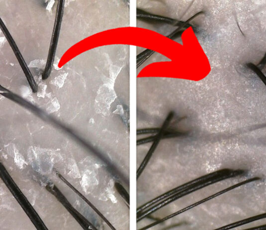 I Always Thought Hair Loss Only Comes With Old Age, Little Did I Know That I Was So Wrong…