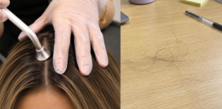 The Biggest Loss I Faced So Far Cost Me More Than My Hair Loss