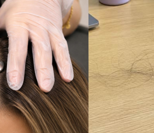 The Biggest Loss I Faced So Far Cost Me More Than My Hair Loss