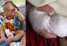 Thai Hospital Expresses Regret After Nursing Assistant Accidentally Severs 1-Year-Old Boy’s Fingertip Bandaged 1-year-old boy after Thai hospital nursing assistant severed fingertip during IV removal