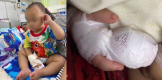 Bandaged 1-year-old boy after Thai hospital nursing assistant severed fingertip during IV removal