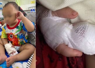 Thai Hospital Expresses Regret After Nursing Assistant Accidentally Severs 1-Year-Old Boy’s Fingertip Bandaged 1-year-old boy after Thai hospital nursing assistant severed fingertip during IV removal